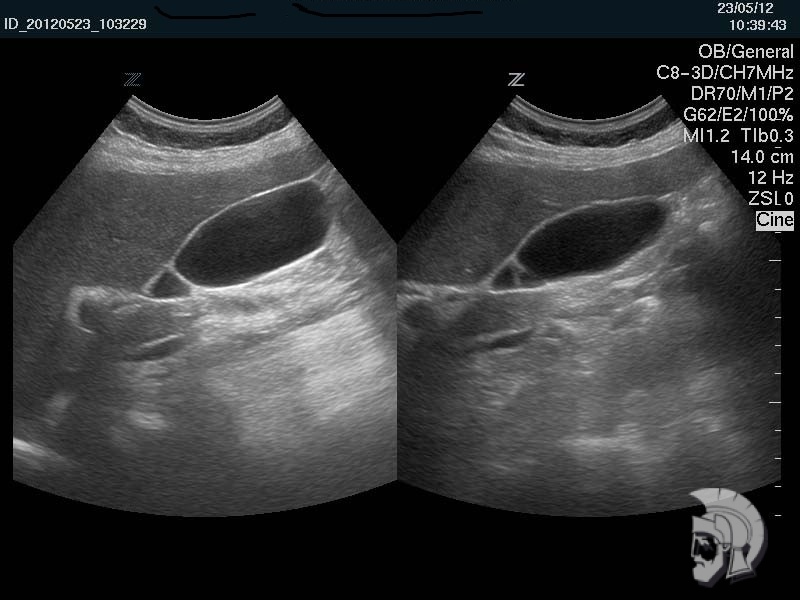 Перетяжка в нижней трети желчного пузыря мужчины 43 лет