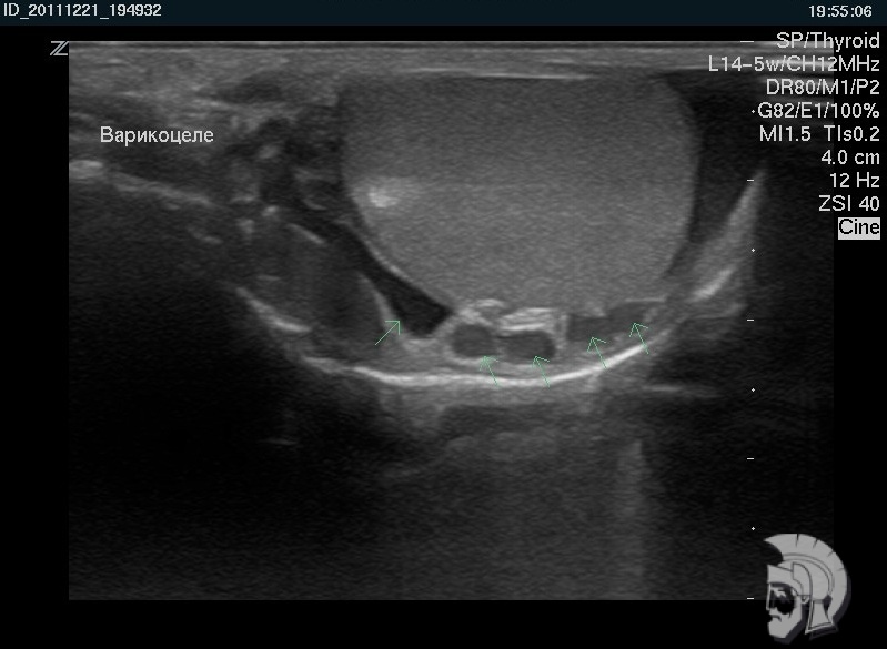 варикоцеле