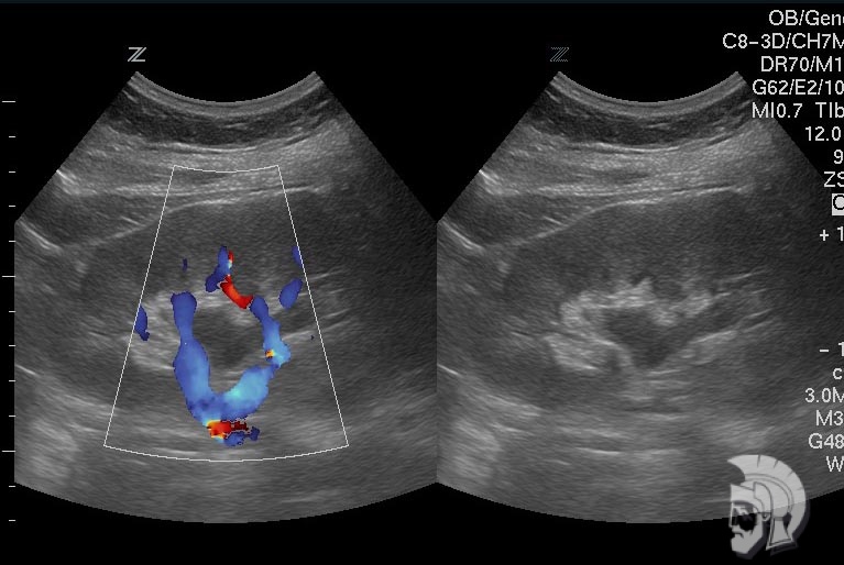 Пиелоэктазия /расширение почечной лоханки/ левой почки у подростка 16 лет