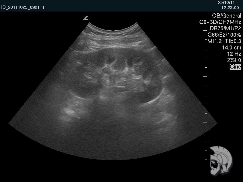 Правая почка мужчины 39 лет с хроническим пиелонефритом и стажем заболевания 10 лет