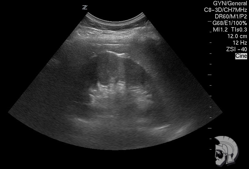 Эхо - структура здоровой почки мужчины 35 лет